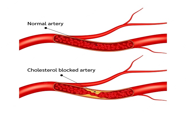 Vegetable Reduces Cholesterol Quickly